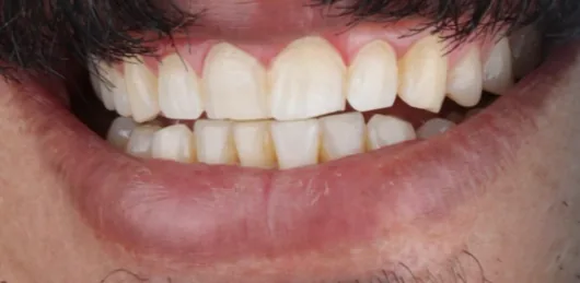 قبل العلاج